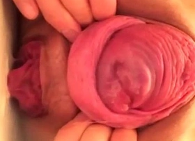 Japanese prolapse