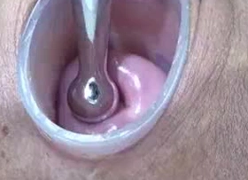 Japanese Wife Open Cervix Wide to watch inside Uterus